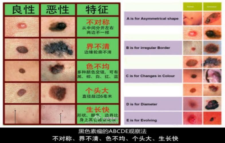 黑色素瘤和普通痣怎么区别 黑色素瘤和普通痣的区别详解